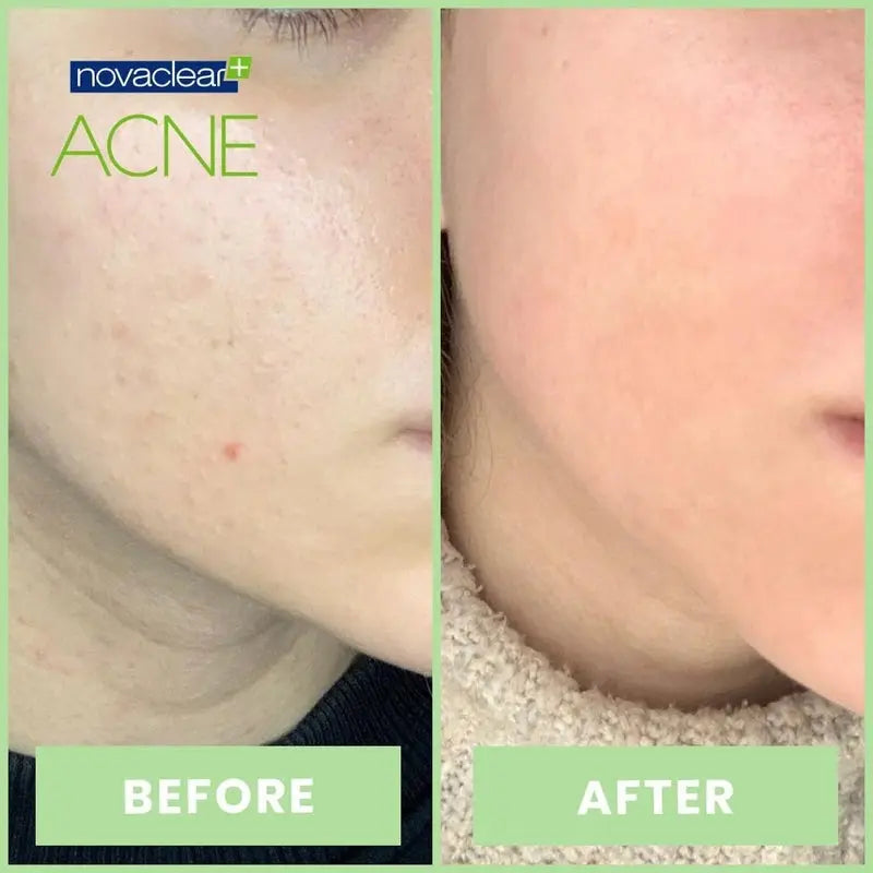 Novaclear Acne Kit With Acne Facial Foam 100ml + Acne Toner 150ml + Acne Cream For Oily, Combination & Acne-Prone Skin 40ml Novaclear