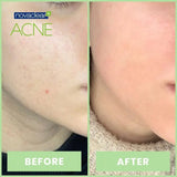 Novaclear Acne Kit With Acne Facial Foam 100ml + Acne Toner 150ml + Acne Cream For Oily, Combination & Acne-Prone Skin 40ml Novaclear